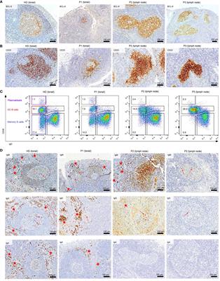 Deciphering imprints of impaired memory B-cell maturation in germinal centers of three patients with common variable immunodeficiency